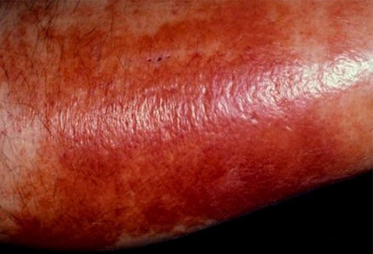 Skin Infections
